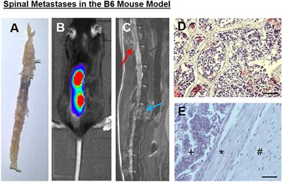 Role of mTOR and VEGFR Inhibition in Prevention of Metastatic Tumor Growth in the Spine